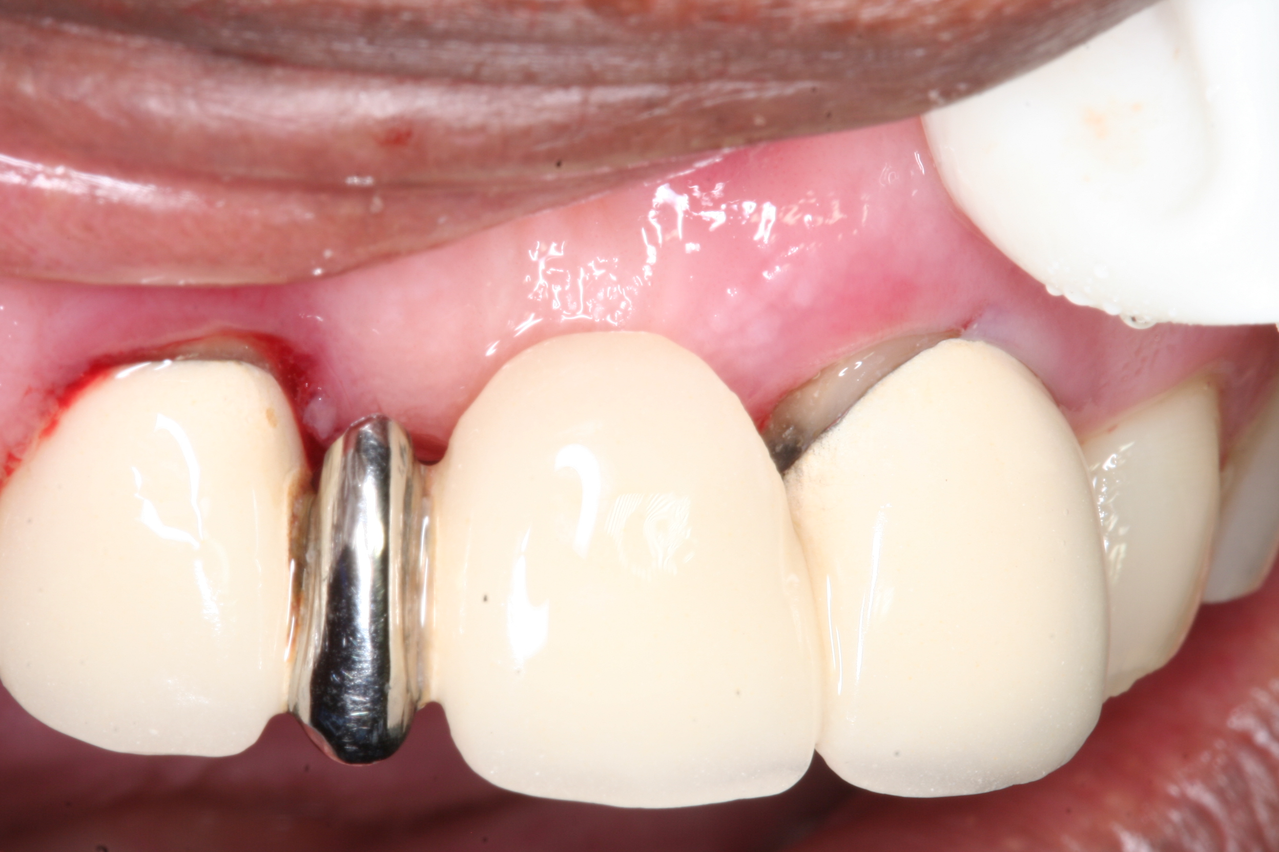 Gold Front Tooth 19 Rappers Who Wear Gold Teeth Grills Body Art Guru